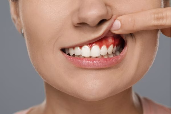 Infecciones y abscesos dentales