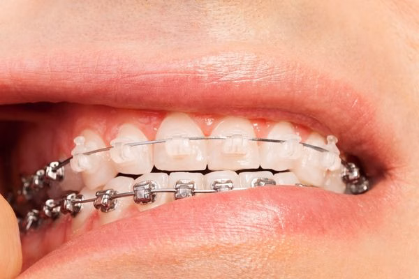 Ortodoncia para casos complejos